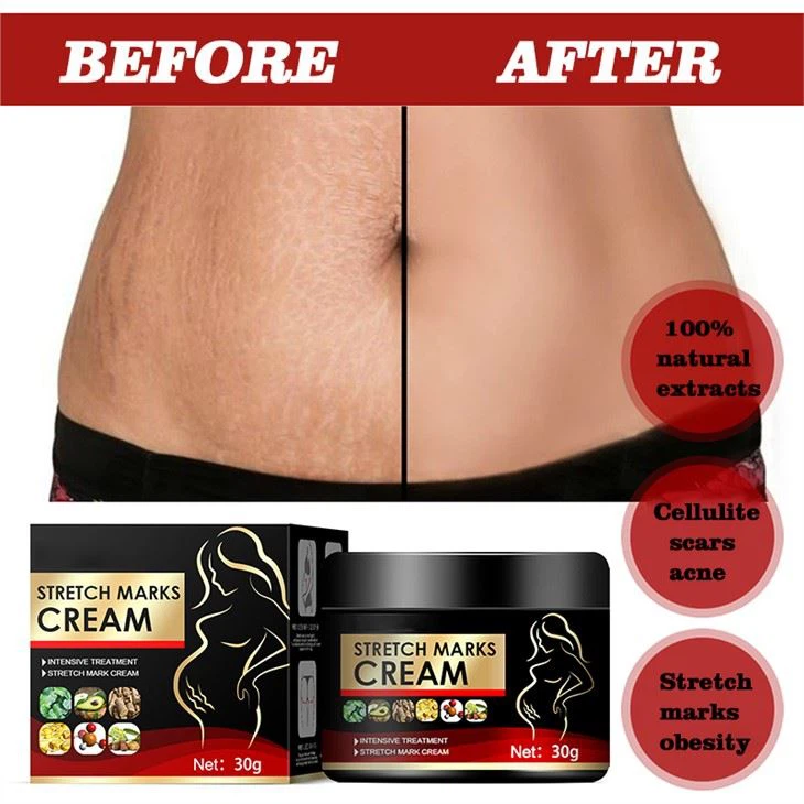 Best Stretch Mark Treatment